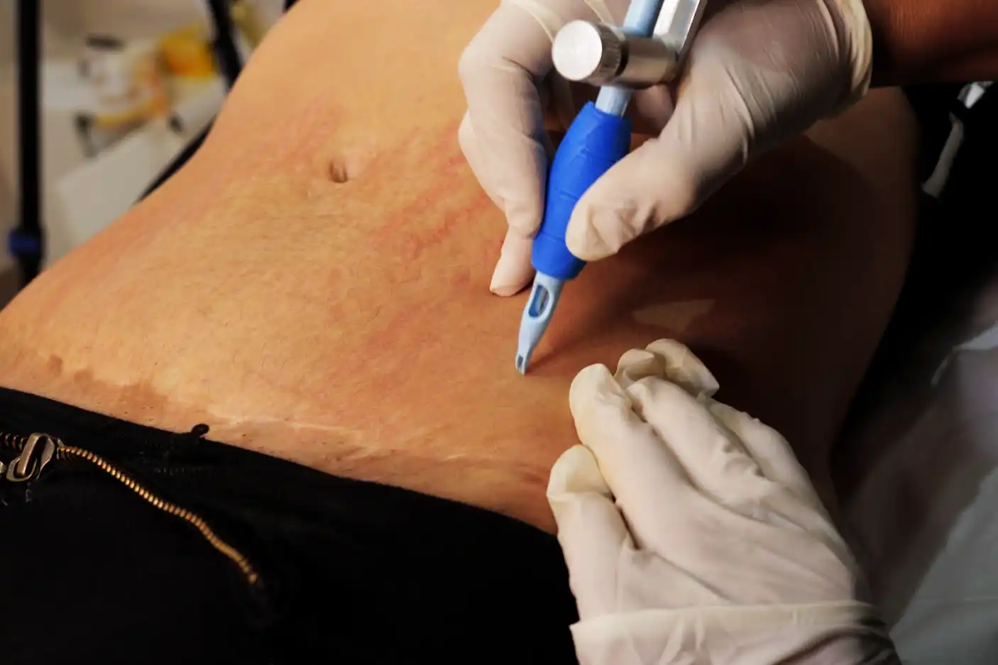 Camuflagem de cicatrizes