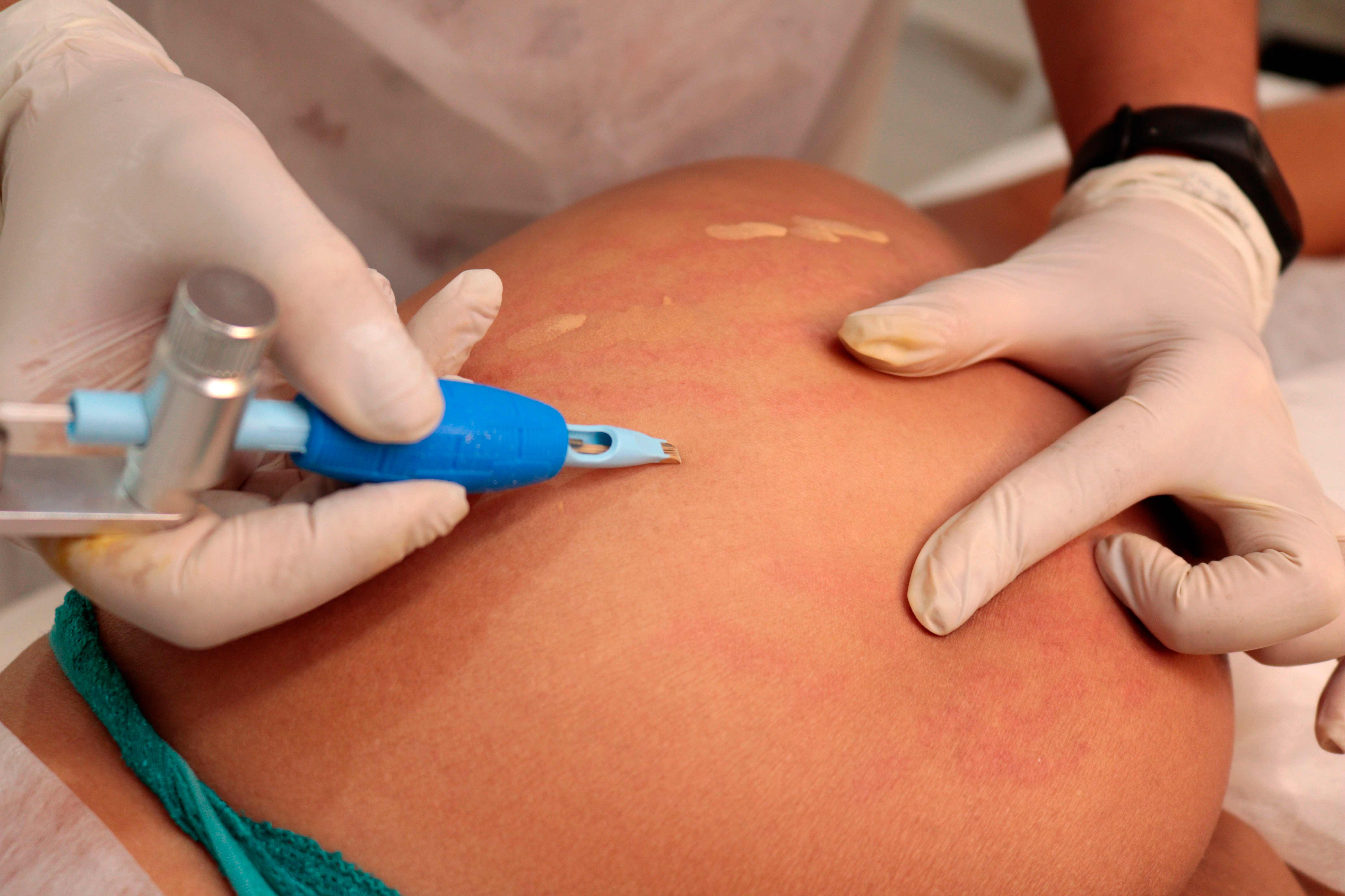 Clareamento de cicatrizes