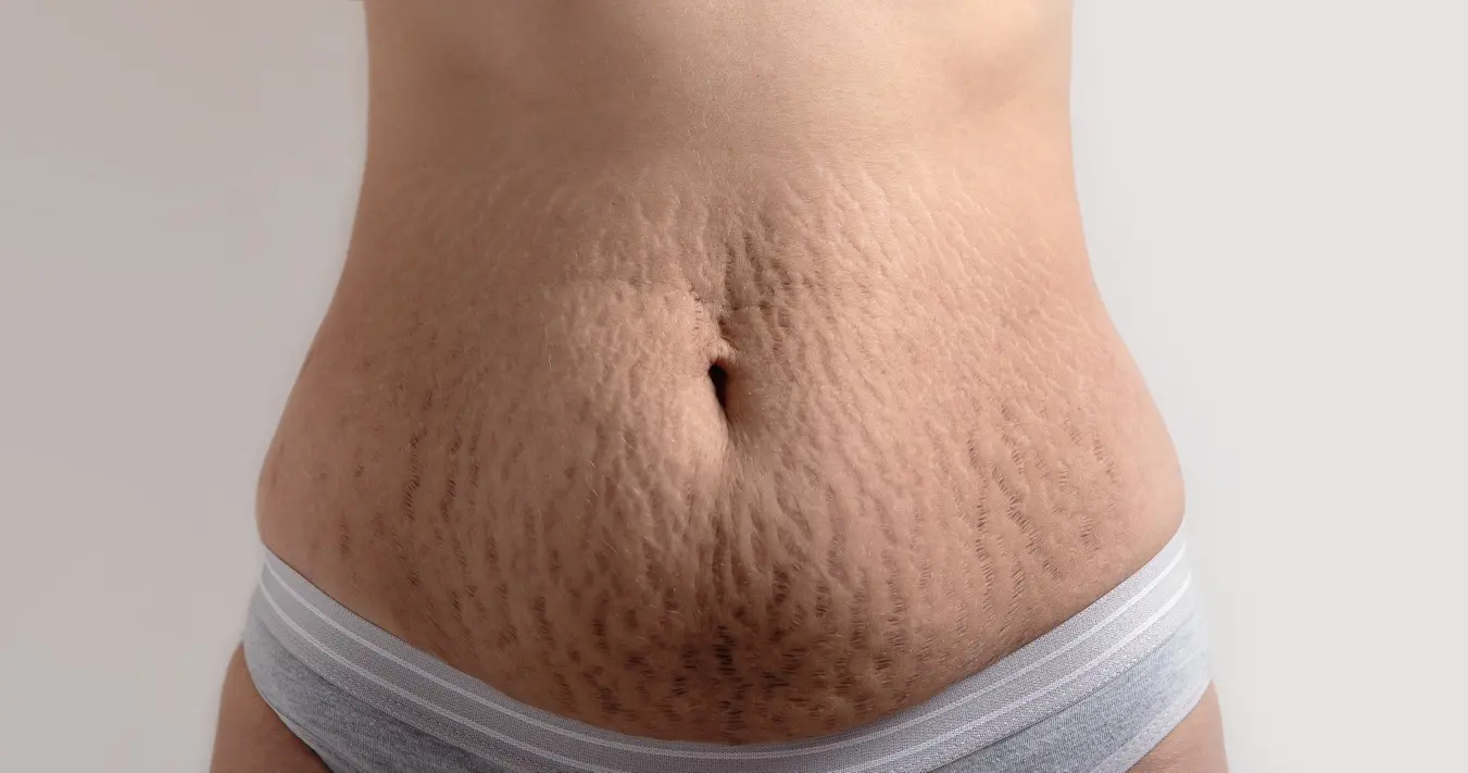 Tratamento de estrias com dermocosméticos